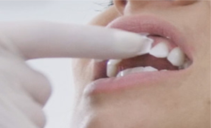 Auftragen von Mousse auf die Zähne eines Patienten nach der Bleaching-Behandlung bei Zahnärzten am Marienplatz.