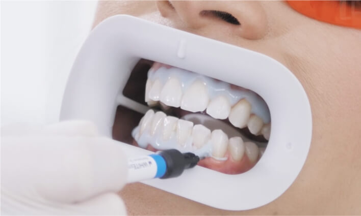 Das Zahnfleisch eines Patienten während einer Bleaching-Behandlung bei der Zahnklink namens Zahnärzte am Marienplatz in München.
